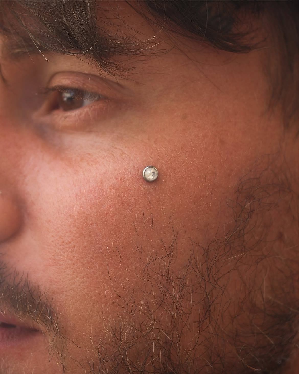 Dermal